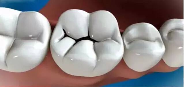 亳州补牙多少钱一颗？