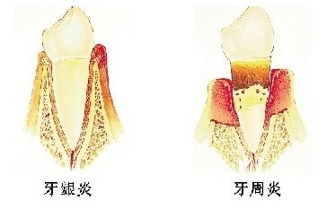 牙龈炎和牙周炎的区别？